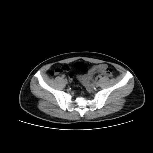 Acute appendicitis and COVID 19 pneumonia (Radiopaedia 76604-88380 Axial non-contrast 103).jpg