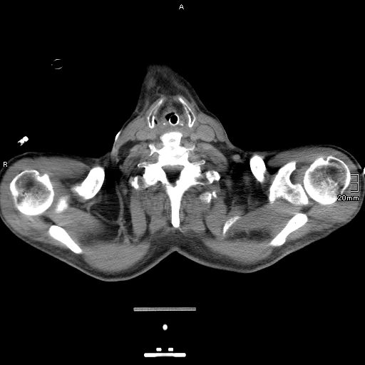 Acute aspiration pneumonitis (Radiopaedia 55642-62166 Axial liver window 2).jpg