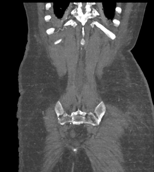 File:Acute bleed from gastric fundus biopsy site (Radiopaedia 35201-36737 Coronal C+ arterial phase 49).png