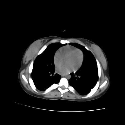 File:Acute calculous cholecystitis in patient with osteopetrosis (Radiopaedia 77871-90159 Axial non-contrast 6).jpg