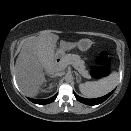 File:Acute cholecystitis and ureteric colic (Radiopaedia 42330-45444 Axial prone 23).jpg
