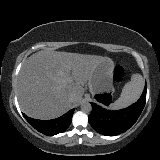 File:Acute cholecystitis and ureteric colic (Radiopaedia 42330-45444 Axial prone 8).jpg