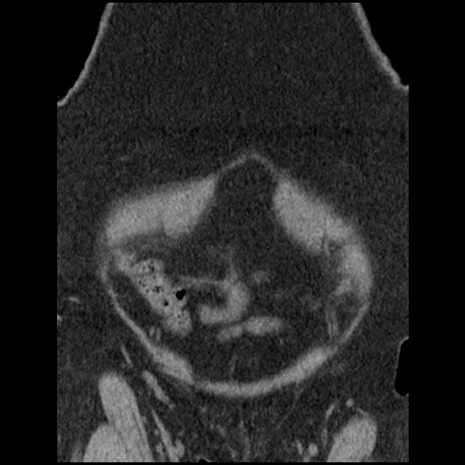 Acute cholecystitis and ureteric colic (Radiopaedia 42330-45444 Coronal prone 21).jpg