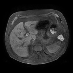 Acute cholecystitis complicated by pylephlebitis (Radiopaedia 65782-74915 Axial T1 fat sat 33).jpg