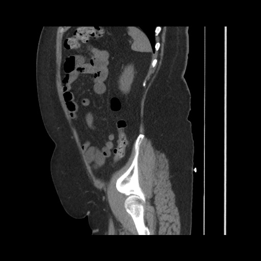 Acute cholecystitis with tensile fundus sign (Radiopaedia 71394-81723 Sagittal non-contrast 128).jpg