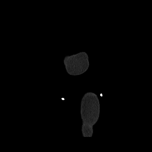 Acute cholecystitis with tensile fundus sign (Radiopaedia 71394-81723 Sagittal non-contrast 173).jpg