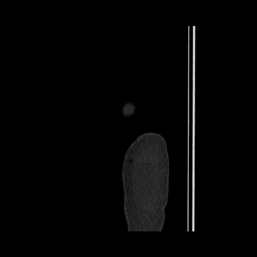 Acute cholecystitis with tensile fundus sign (Radiopaedia 71394-81723 Sagittal non-contrast 9).jpg
