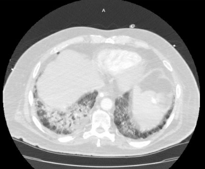 Acute cor pulmonale (ultrasound) (Radiopaedia 83508-98818 Axial lung window 68).jpg