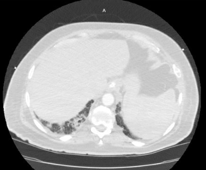 Acute cor pulmonale (ultrasound) (Radiopaedia 83508-98818 Axial lung window 80).jpg