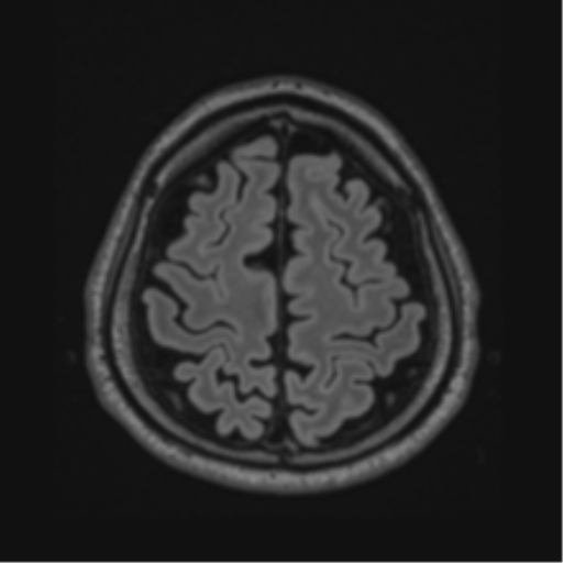 Acute disseminated encephalomyelitis (ADEM)- Anti-NMDA receptor encephalitis (Radiopaedia 54920-61201 Axial FLAIR 57).png