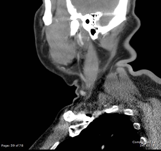Acute epiglottitis (Radiopaedia 54375-60590 Sagittal C+ arterial phase 59).jpg