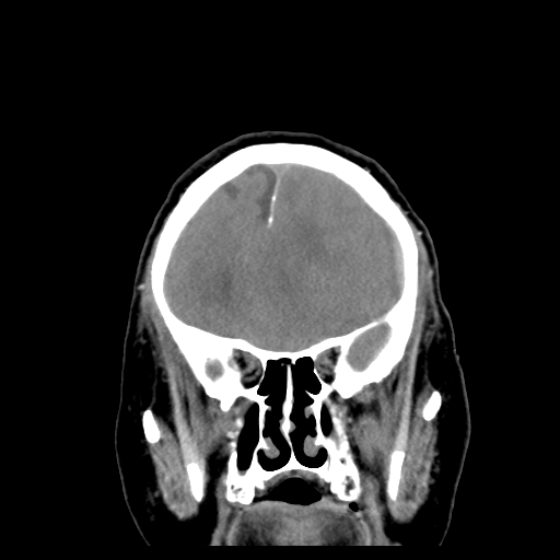 Acute hemorrhagic stroke (Radiopaedia 17507-17223 Coronal non-contrast 14).jpg