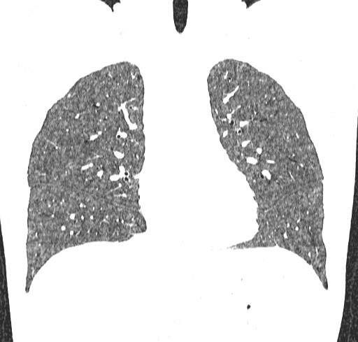 Acute hypersensitivity pneumonitis (Radiopaedia 85293-100870 Coronal lung window 50).jpg