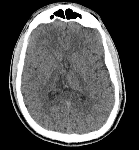Acute ischemic stroke - posterior circulation territory (Radiopaedia 77670-89881 non-contrast 48).jpg