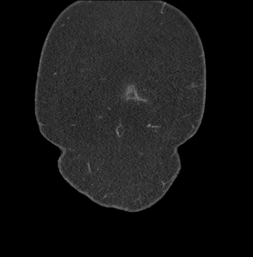 Acute mesenteric venous ischemia (Radiopaedia 46041-50383 Coronal C+ portal venous phase 3).jpg