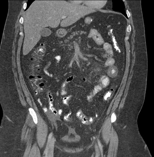 Acute mesenteric venous ischemia (Radiopaedia 46041-50383 Coronal C+ portal venous phase 38).jpg