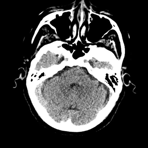 Acute middle cerebral artery territory infarct (Radiopaedia 52380-58283 Axial non-contrast 24).jpg
