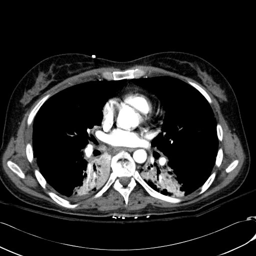 Acute myocardial infarction in CT (Radiopaedia 39947-42415 Axial C+ arterial phase 74).jpg