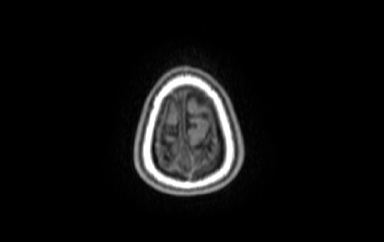 Acute necrotizing encephalitis of childhood (Radiopaedia 67356-76737 Axial T1 4).jpg