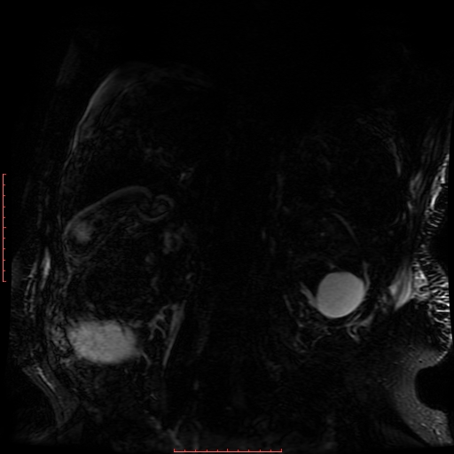 Acute necrotizing pancreatitis (Radiopaedia 28194-28448 Coronal MRCP 11).jpg