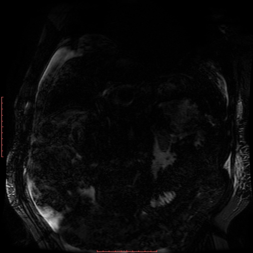 Acute necrotizing pancreatitis (Radiopaedia 28194-28448 Coronal MRCP 55).jpg