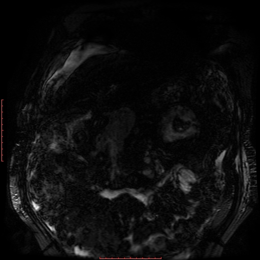 Acute necrotizing pancreatitis (Radiopaedia 28194-28448 Coronal MRCP 82).jpg