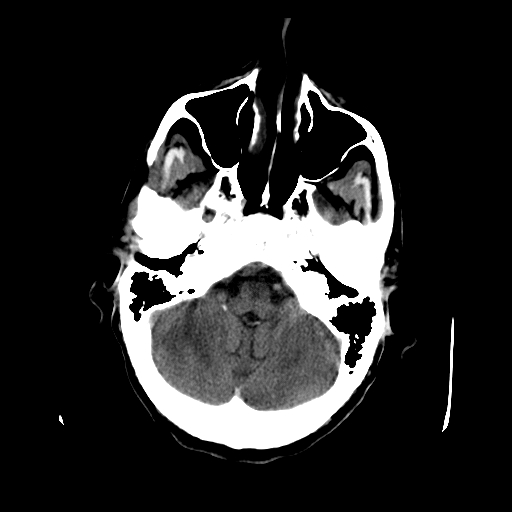 File:Acute necrotizing toxoplasma encephalitis (Radiopaedia 10683-11150 Axial non-contrast 28).jpg