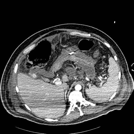 File:Acute pancreatic necrosis (Radiopaedia 13560-18502 Axial C+ portal venous phase 11).jpg