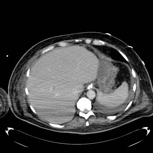 File:Acute pancreatic necrosis (Radiopaedia 13560-18503 Axial C+ portal venous phase 11).jpg