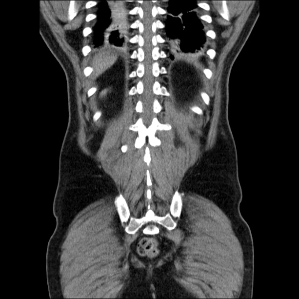 Acute pancreatitis (Radiopaedia 26663-26813 Coronal C+ portal venous phase 53).jpg