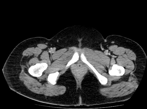 Acute pancreatitis (Radiopaedia 69236-79012 Axial C+ portal venous phase 92).jpg
