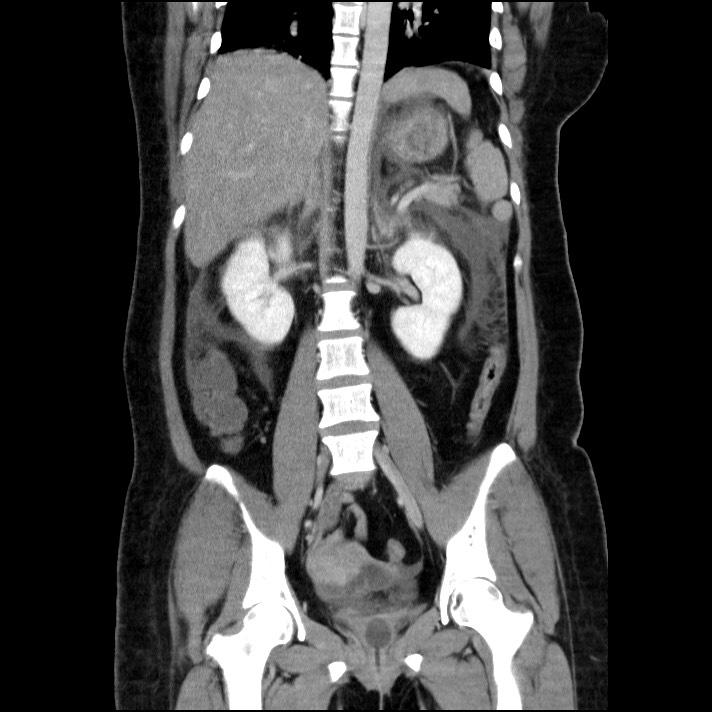 Acute pancreatitis (Radiopaedia 69236-79012 Coronal C+ portal venous phase 35).jpg