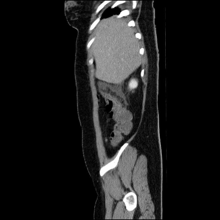 Acute pancreatitis (Radiopaedia 69236-79012 Sagittal C+ portal venous phase 81).jpg