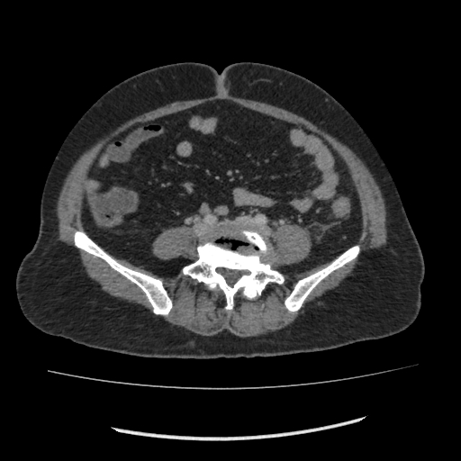 Acute pancreatitis (Radiopaedia 80007-93285 Axial C+ portal venous phase 114).jpg