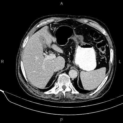 Acute pancreatitis (Radiopaedia 85146-100701 Axial C+ portal venous phase 18).jpg