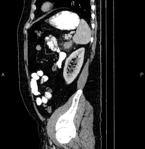 Acute pancreatitis (Radiopaedia 85390-101010 Sagittal C+ portal venous phase 80).jpg