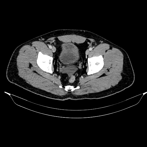 File:Acute pancreatitis (Radiopaedia 87428-103757 Axial C+ portal venous phase 88).jpg
