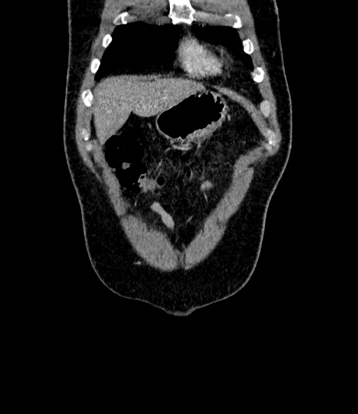 Acute pancreatitis (Radiopaedia 87428-103757 Coronal C+ portal venous phase 12).jpg