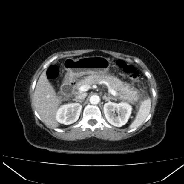 Acute pancreatitis - Balthazar C (Radiopaedia 26569-26714 Axial C+ arterial phase 29).jpg