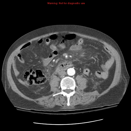 Acute pancreatitis with incidental pancreatic lipoma (Radiopaedia 10190-10730 Axial C+ arterial phase 59).jpg