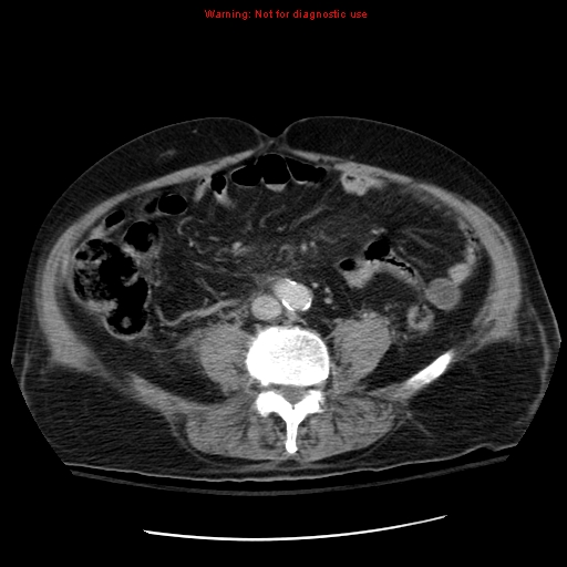 File:Acute pancreatitis with incidental pancreatic lipoma (Radiopaedia 10190-10730 Axial C+ portal venous phase 48).jpg