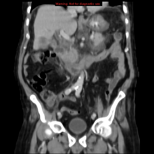 Acute pancreatitis with incidental pancreatic lipoma (Radiopaedia 10190-10730 Coronal C+ portal venous phase 33).jpg