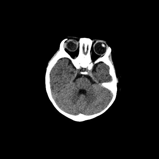 File:Acute phase of hemiconvulsion-hemiplegia epilepsy syndrome (Radiopaedia 29309-29744 Axial non-contrast 38).jpg
