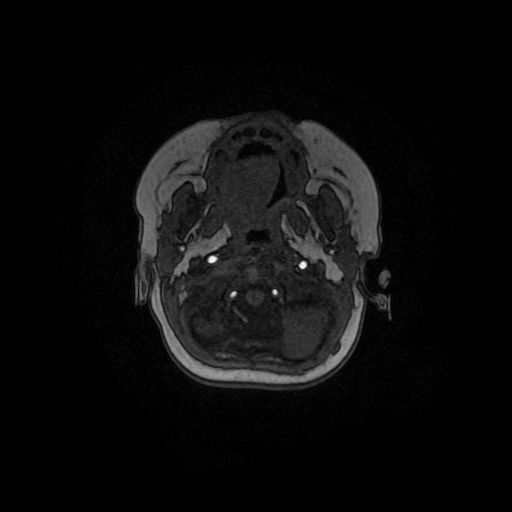 Acute phase of hemiconvulsion-hemiplegia epilepsy syndrome (Radiopaedia 29309-29745 Axial TOF angiography 152).jpg