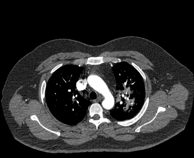 Acute pulmonary embolism with pulmonary infarcts (Radiopaedia 77688-89908 Axial C+ CTPA 16).jpg