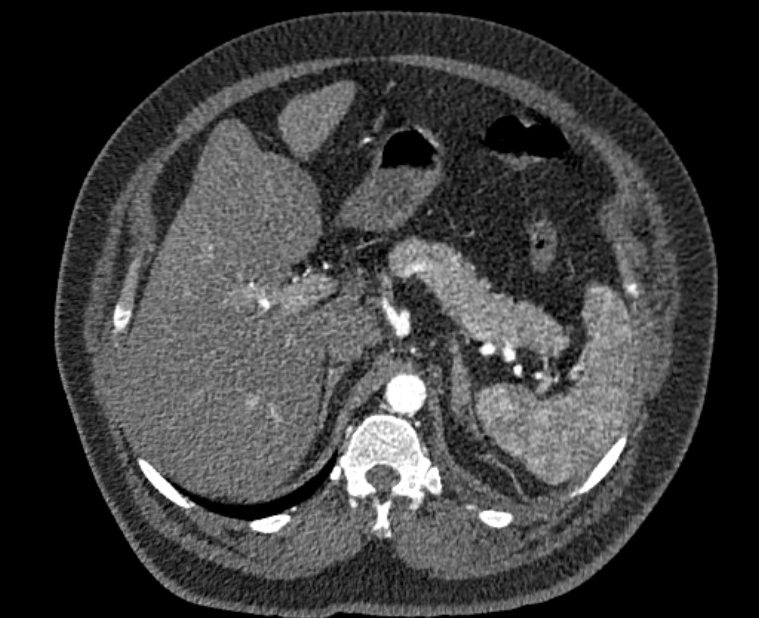 Acute pulmonary embolism with pulmonary infarcts (Radiopaedia 77688-89908 Axial C+ CTPA 75).jpg