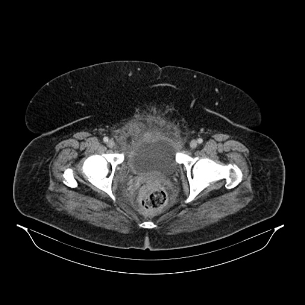 Acute pyelonephritis (Radiopaedia 25657-25837 Axial renal parenchymal phase 77).jpg