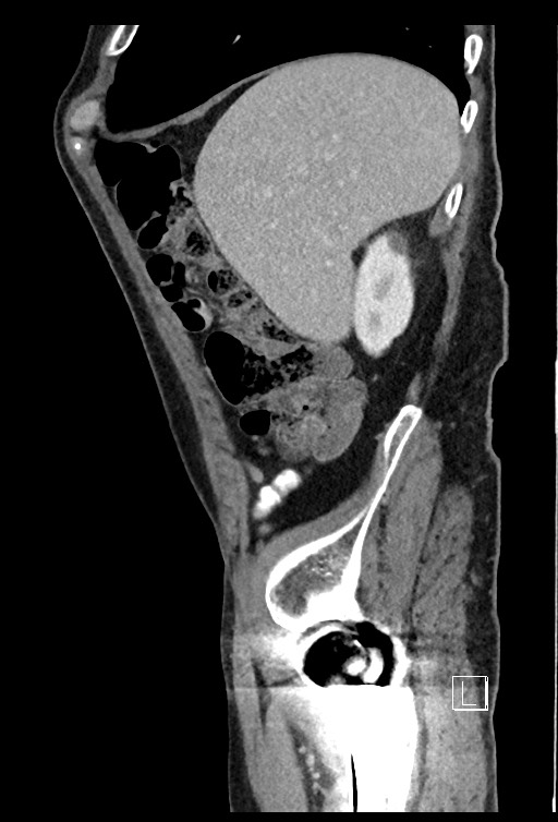 Acute renal infarction - rim capsular enhancement (Radiopaedia 59833-67270 Sagittal C+ portal venous phase 71).jpg