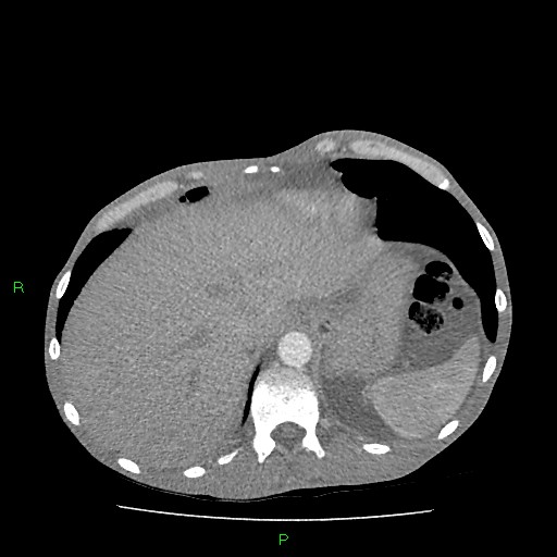File:Acute right lung abscess (Radiopaedia 34806-36258 Axial C+ arterial phase 166).jpg