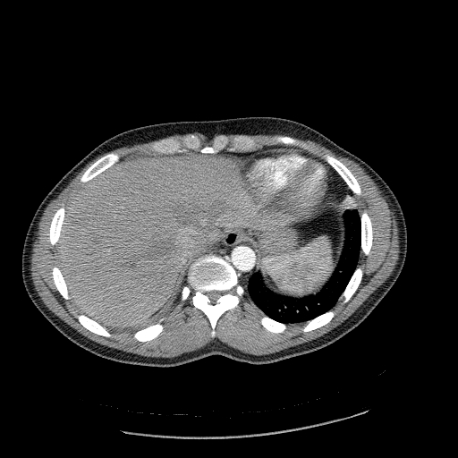Acute segmental pulmonary emboli and pulmonary infarction (Radiopaedia 62264-70444 Axial C+ CTPA 96).jpg